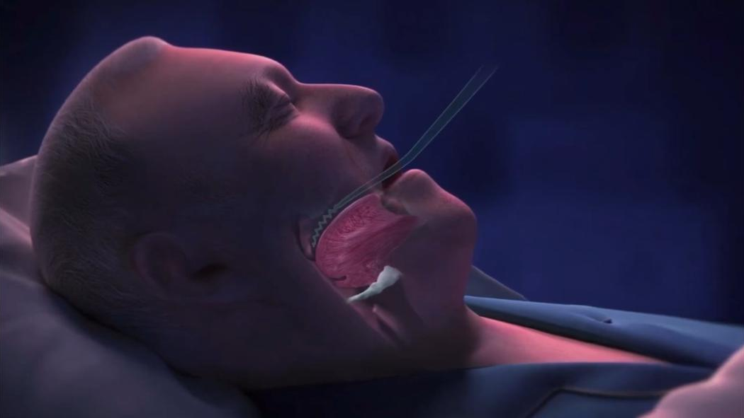 sleep-apnea